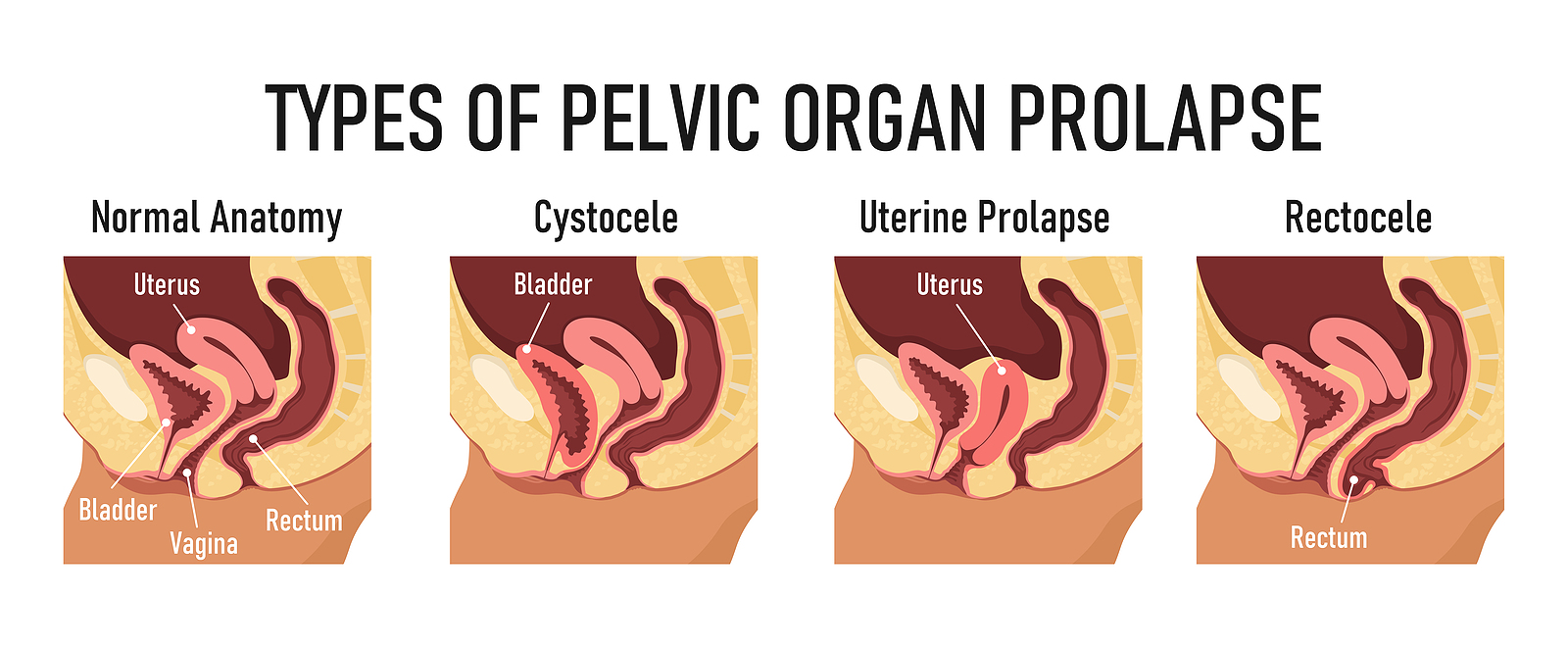 The Major Types of Pelvic Organ Prolapse and Their Differences | Advanced  Gynecology